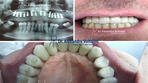  Poliuretano: O Material Maravilhoso para Moldes Flexíveis e Implantes Duradouros?!